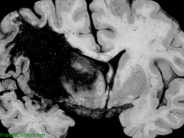 Putaminal Hemorrhage, Coronal section through brain